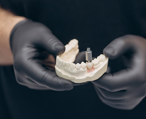 dental implants maple ridge