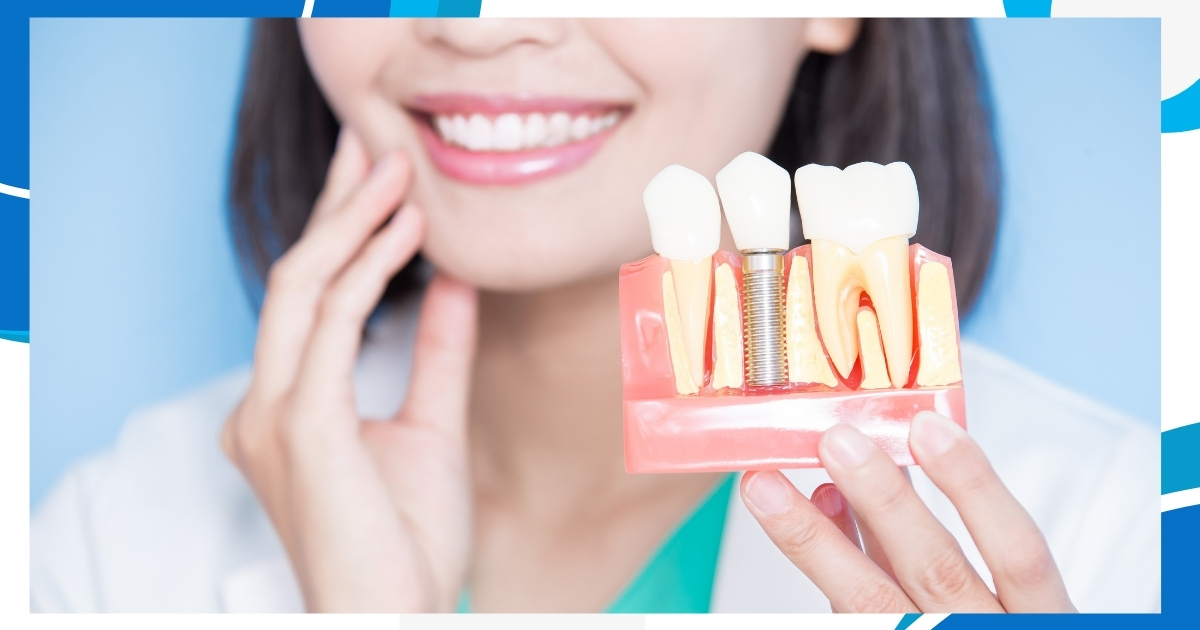 Types Of Dental Implants | White House Dental Maple Ridge